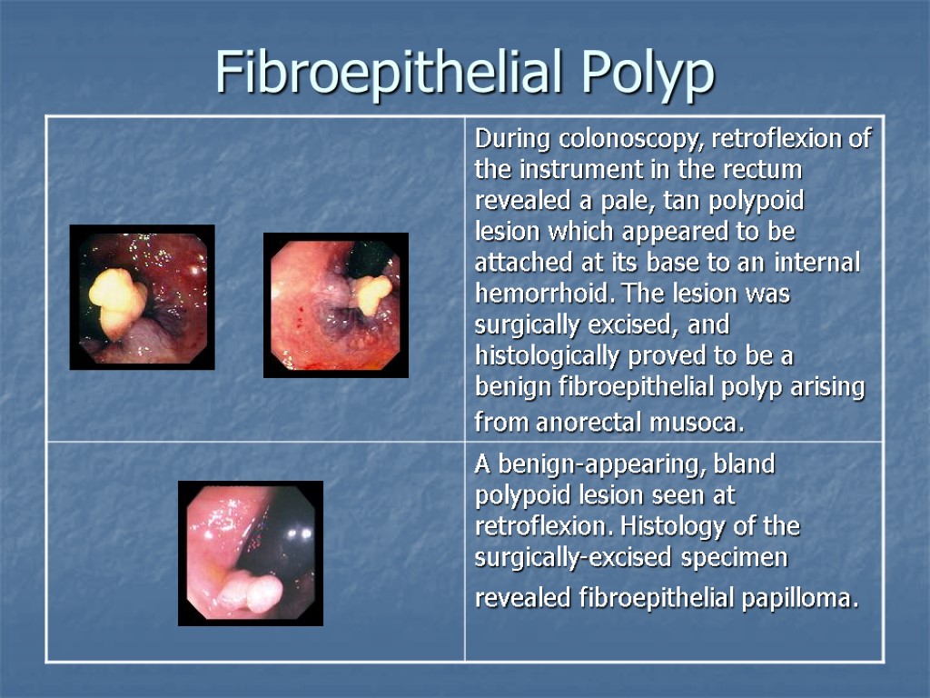 fibroepithelial polyp 意味 _ 線維上皮性間質ポリープ 症例 – NVRCQ